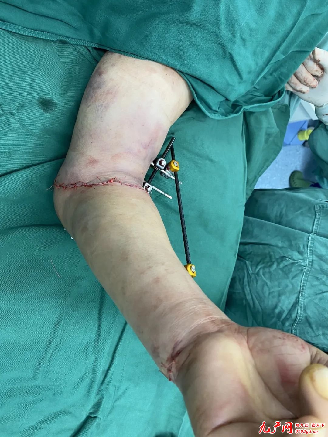 断肢再植｜九江市第一人民医院骨科手足外科成功为机器绞断手臂患者断臂 